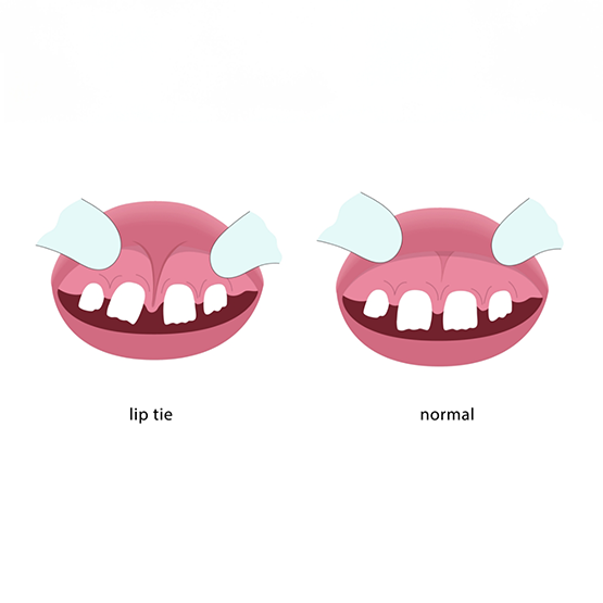 Illustration of normal mouth next to one with a lip tie between two front teeth