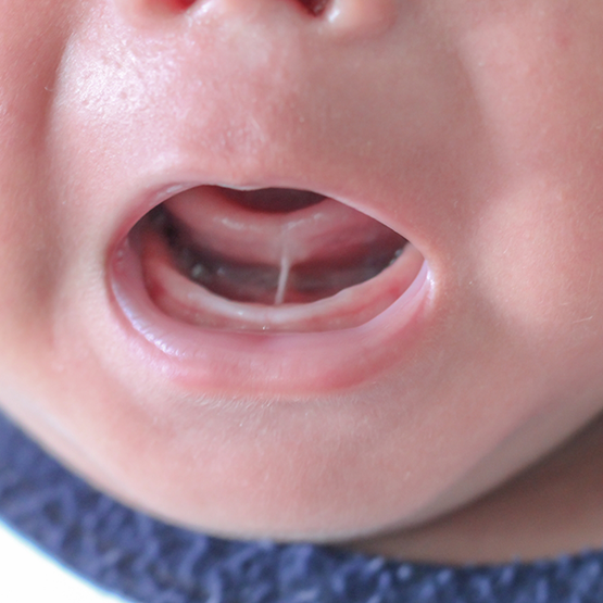 Close up of a babys mouth with a tongue tie