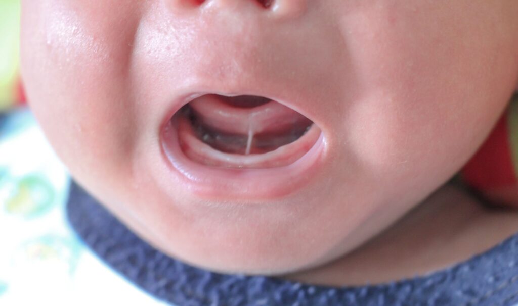 Closeup of infant's tongue tie